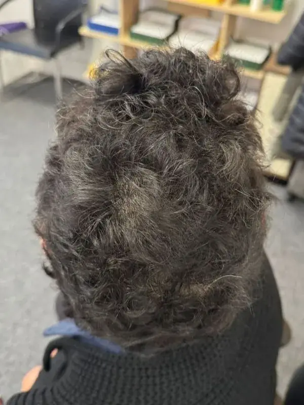 Leah's alopecia areata recovery result