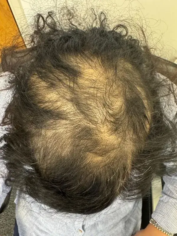 Before treatment - Alopecia Areata