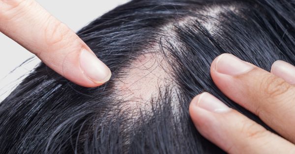 Alopecia Areata treatments