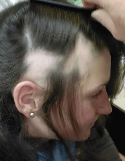 Alopecia Areata