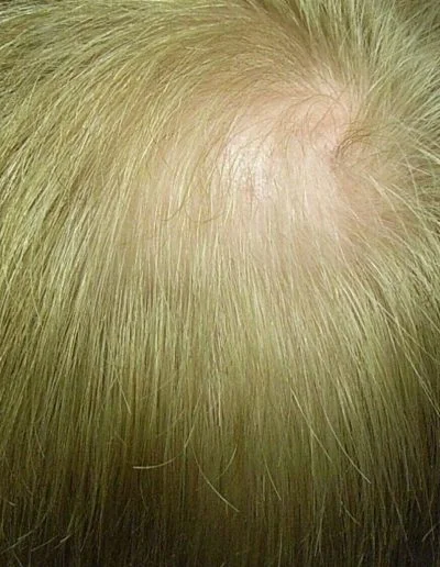 Male Pattern Baldness