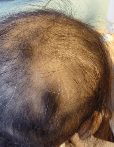 Telogen Effluvium