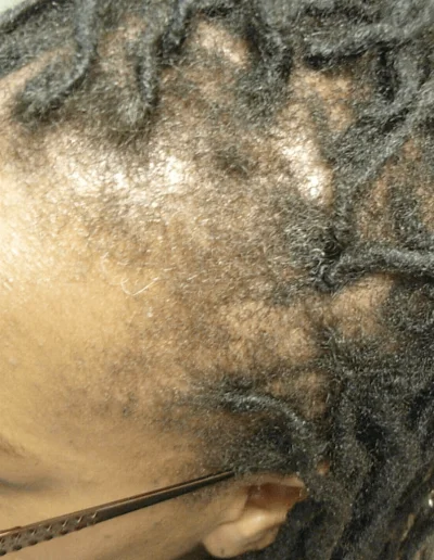 Traction Alopecia