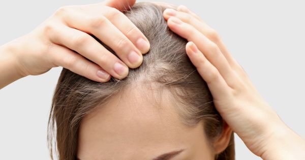 Diffuse Hair Loss treatments