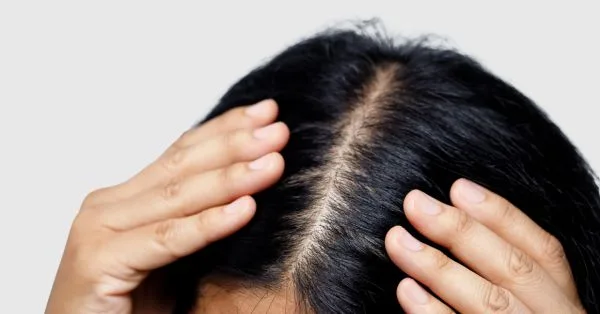 Female Pattern Balding treatment results in Aberdeen