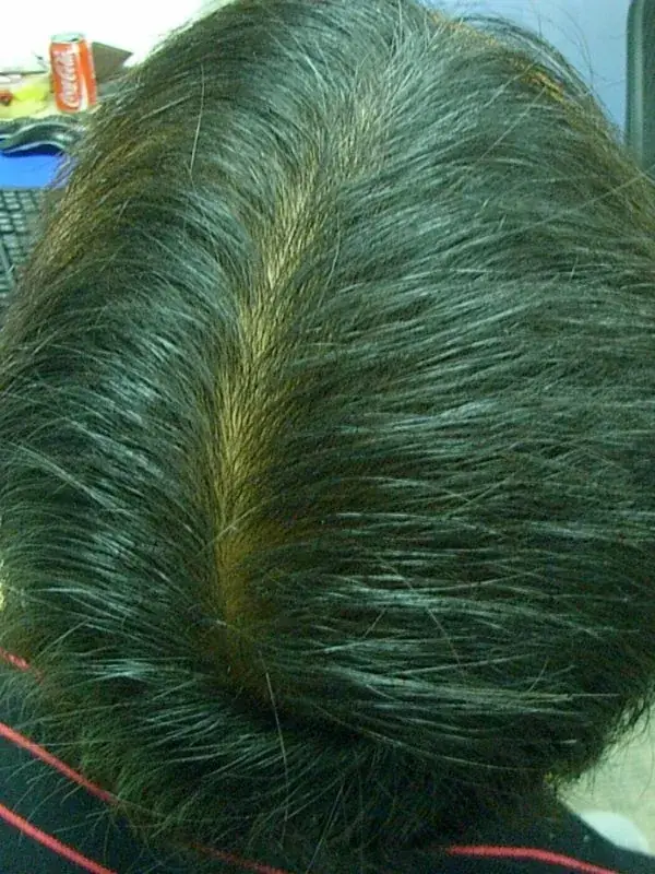 Asim's male pattern baldness treatment result