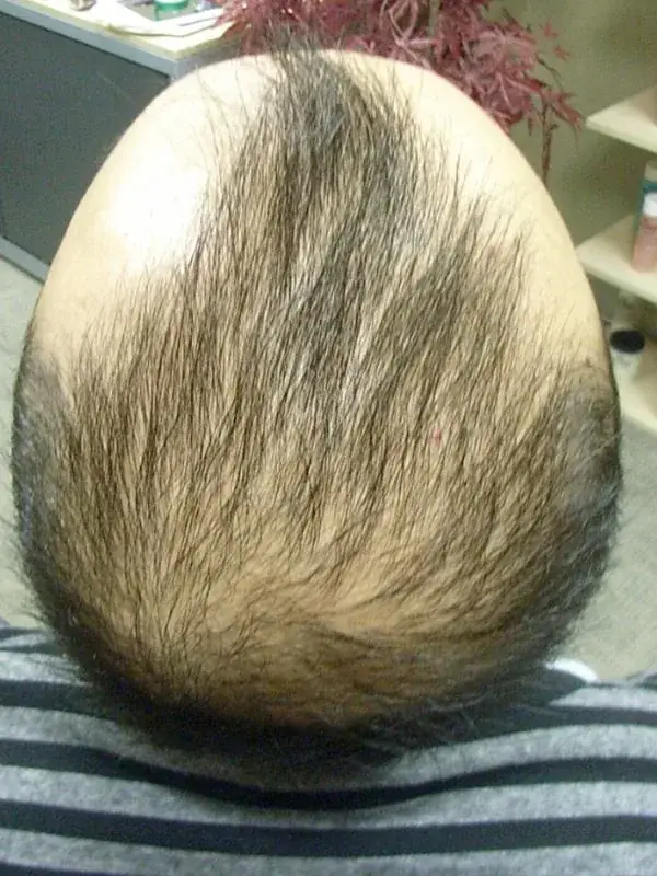 Before treatment - Male Pattern Baldness