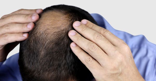 Male Pattern Balding treatments