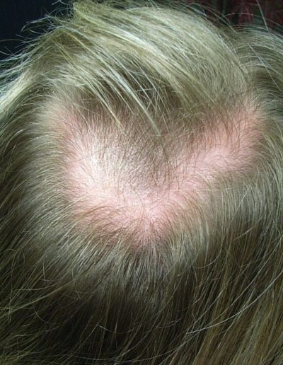 Sophie before treatment — Alopecia Areata