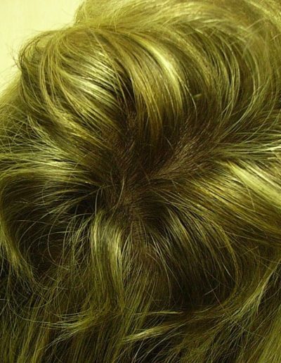Sophie after treatment — Alopecia Areata