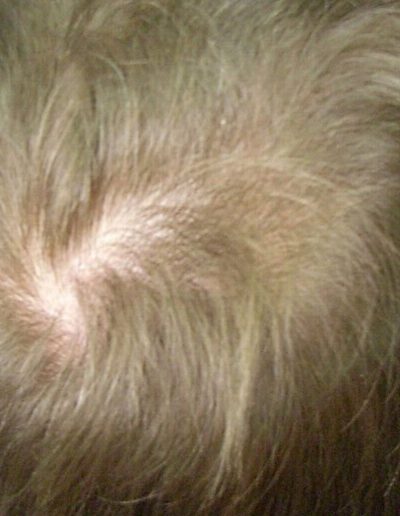 Cameron before treatment — Male Pattern Baldness