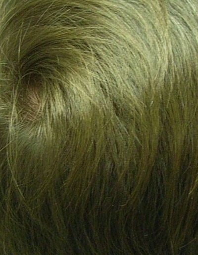 Cameron after treatment — Male Pattern Baldness