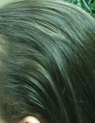 Sue — Telogen Effluvium after treatment