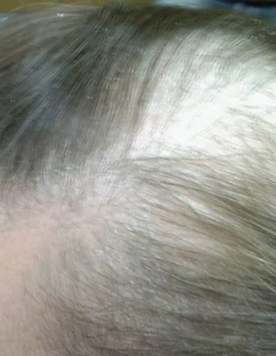 Sue — Telogen Effluvium before treatment