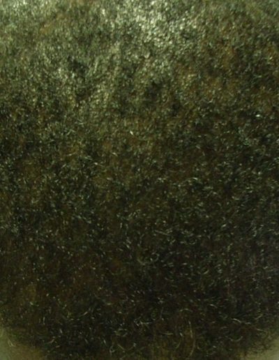 Jordan after treatment — Male Pattern Baldness