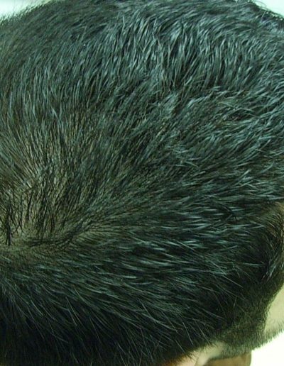 Angie after treatment — Telogen Effluvium