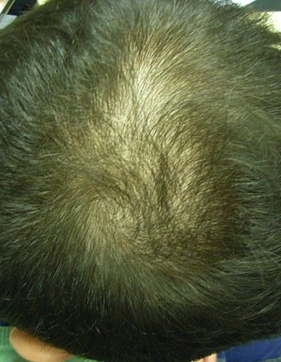 Angie before treatment — Telogen Effluvium