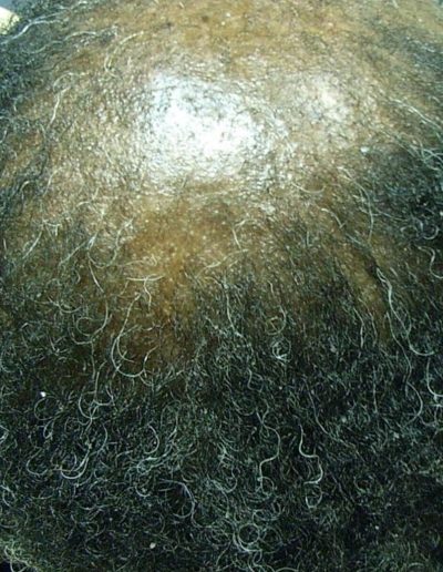 Davina before treatment — Alopecia Areata