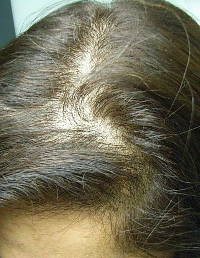 Farah before treatment — Female Pattern Balding