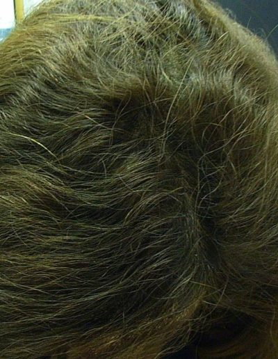 Farah after treatment — Female Pattern Balding