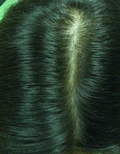 Anna after treatment — Telogen Effluvium