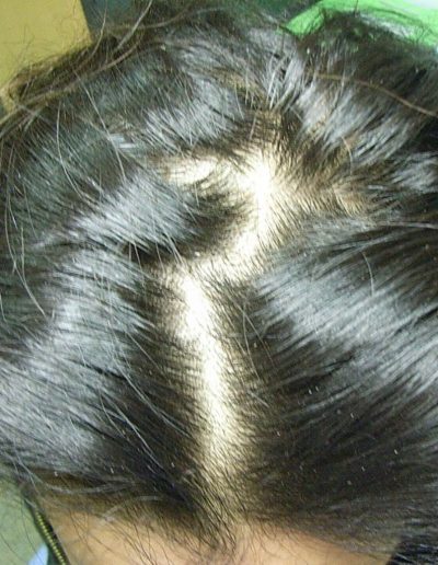 Anna before treatment — Telogen Effluvium