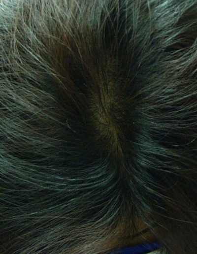 Lisa after treatment — Female Pattern Balding