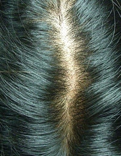 Lisa before treatment — Female Pattern Balding
