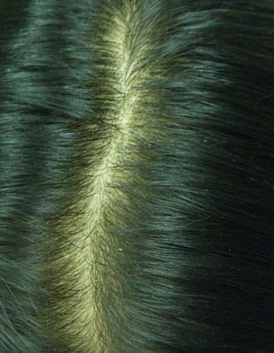 Nadia Female Pattern Balding — After