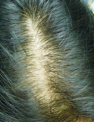 Nadia Female Pattern Balding — Before