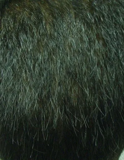 After treatment - Male Pattern Baldness - Merlin