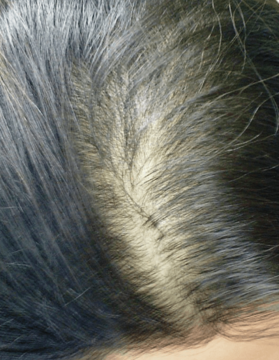 Abbey before treatment — Telogen Effluvium
