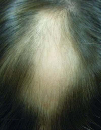 Bianca before treatment — Alopecia Areata