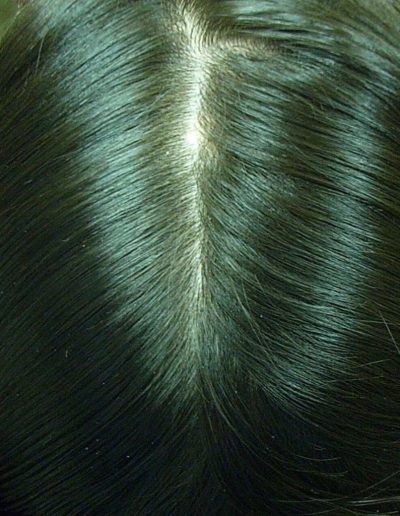 Bianca after treatment — Alopecia Areata