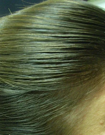 After treatment - Female Pattern Balding - Lisa