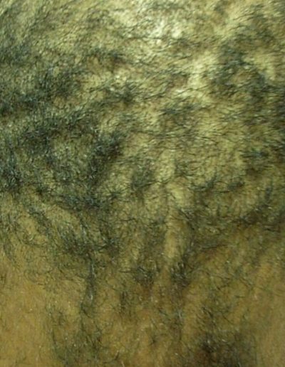 Darren Male Pattern Baldness — Before