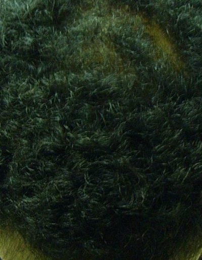 Darren Male Pattern Baldness — After
