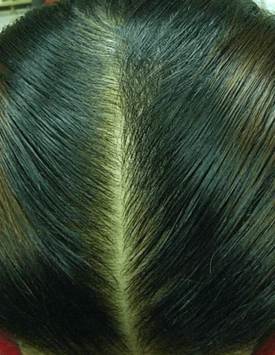 Abbey — Telogen Effluvium after treatment
