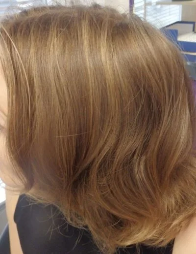 Alice 24 Year Old With Alopecia Areata Hair Successful Treatment