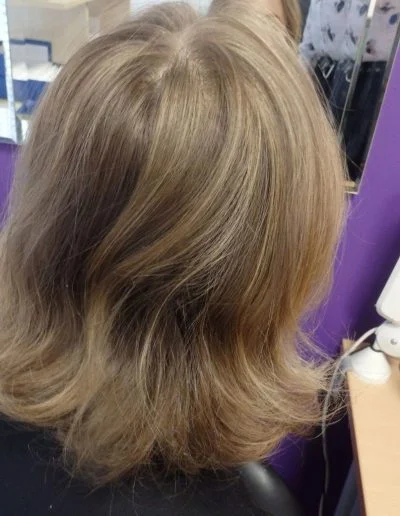 Alice — Alopecia Areata after treatment