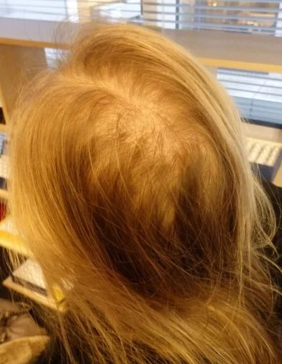 Alice 24 Year Old With Alopecia Areata Hair Before Treatment
