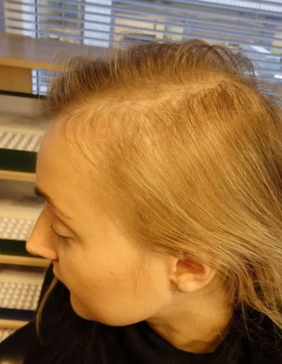 Alice — Alopecia Areata before treatment
