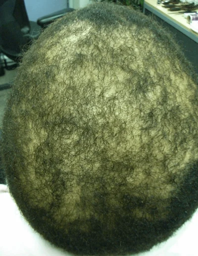 Chemical Damage Hair Loss