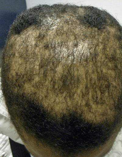 Angela before treatment — Traction Alopecia
