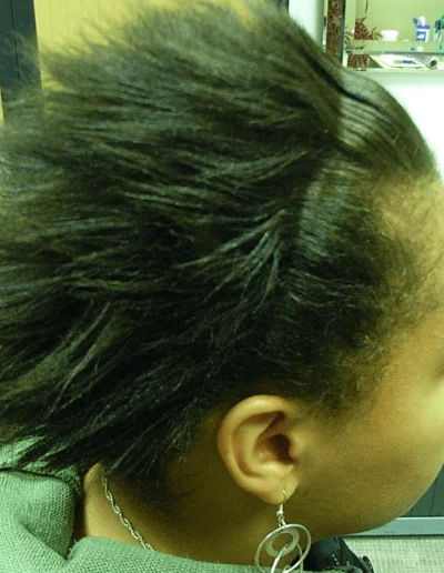 Black Hair Lostraction Alopecia Treated