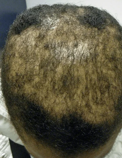 Angela Chemical Damage Pre Treatment