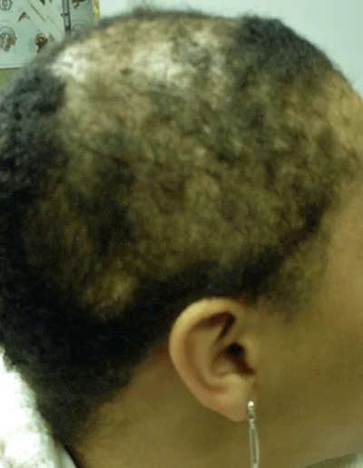 Angela Chemical Damage Black Hair Loss