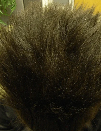 Tranction Alopecia Full Recovery