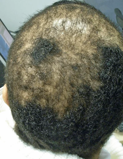Traction And Weave Hair Loss