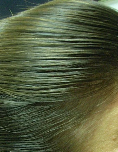 8 Annas Female Pattern Balding Post Treatment